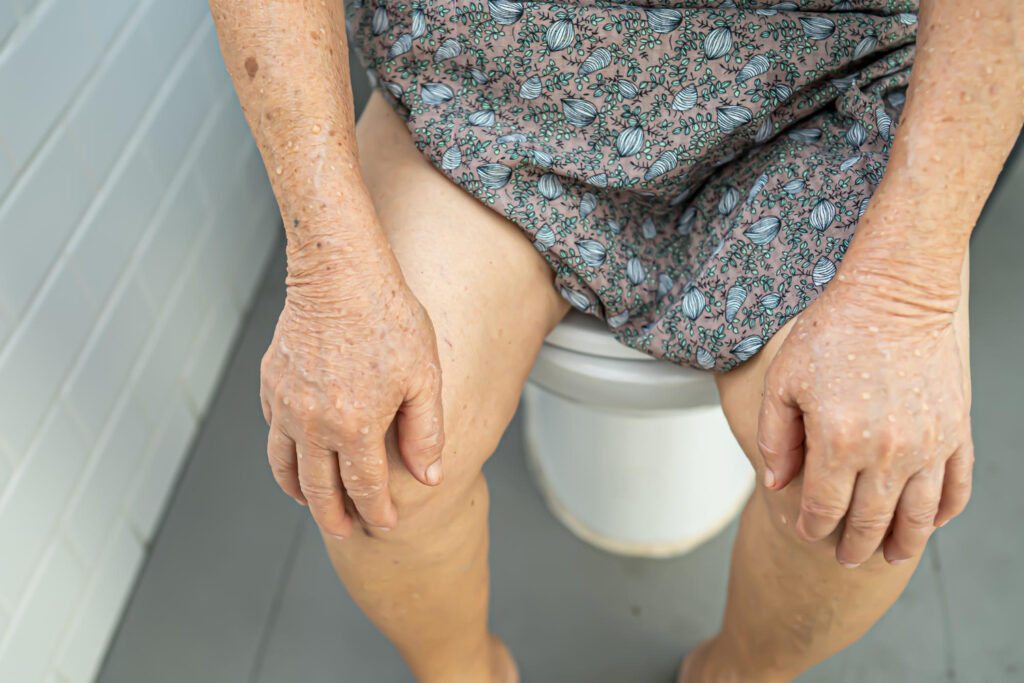 Como Prevenir e Tratar as Hemorroidas em Idosos