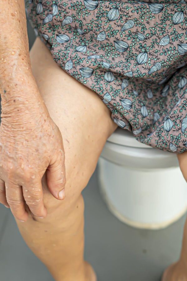 Como Prevenir e Tratar as Hemorroidas em Idosos