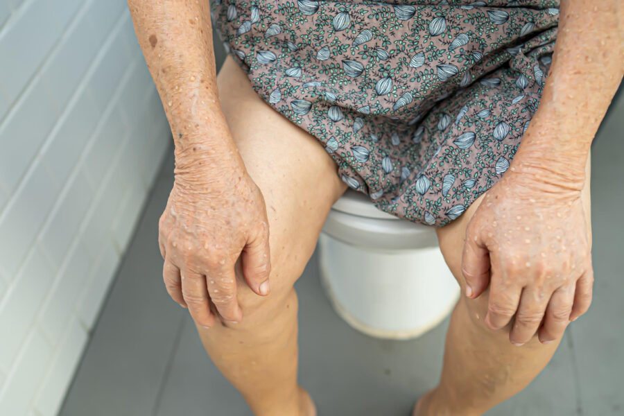 Como Prevenir e Tratar as Hemorroidas em Idosos
